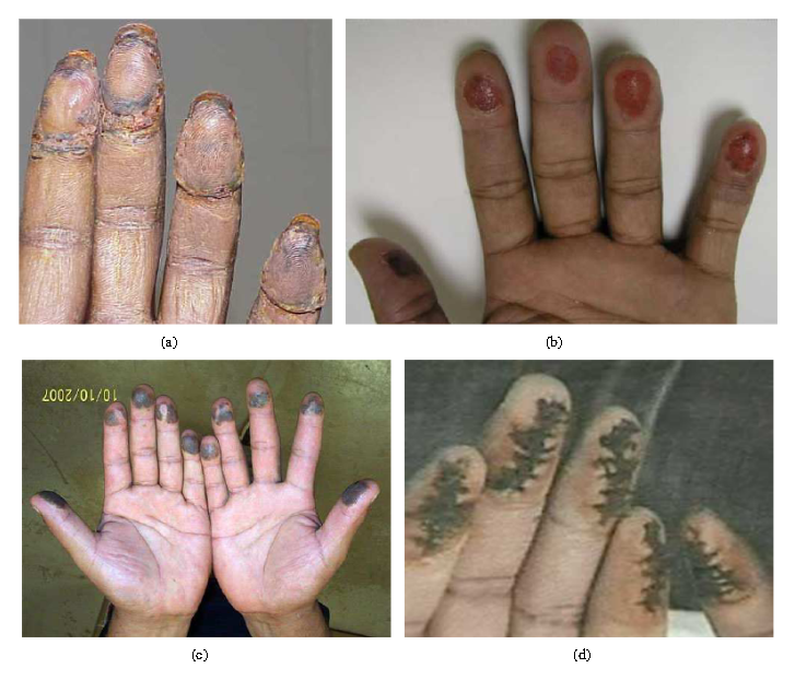 Examples of fingerprint alteration: a) Transplanted from feet b) Bitten c) Acid-burned d) Stitched