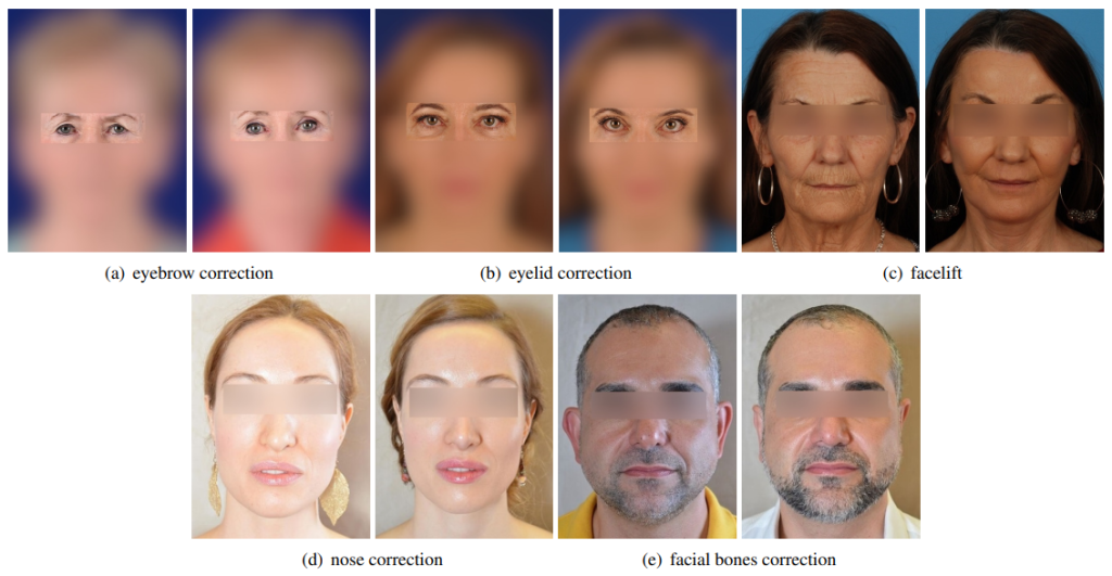 Before and after images of popular facial plastic surgeries