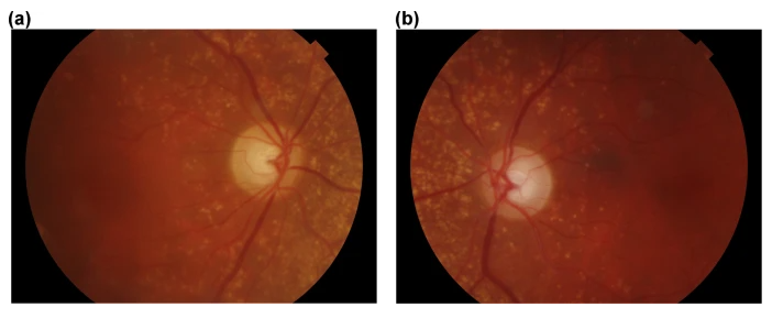 Images of human retina from the PAPILA dataset used for training retinal recognition systems